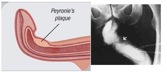 choroba penisa peyroni